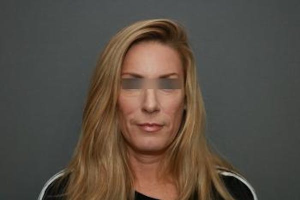 Before and after image of Revision Rhinoplasty Results Orange County