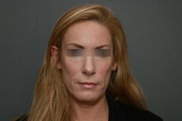 Before and after image of Revision Rhinoplasty Results Orange County