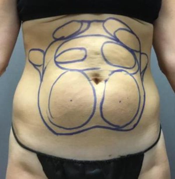 Before and After image of Liposuction in Ladera Ranch