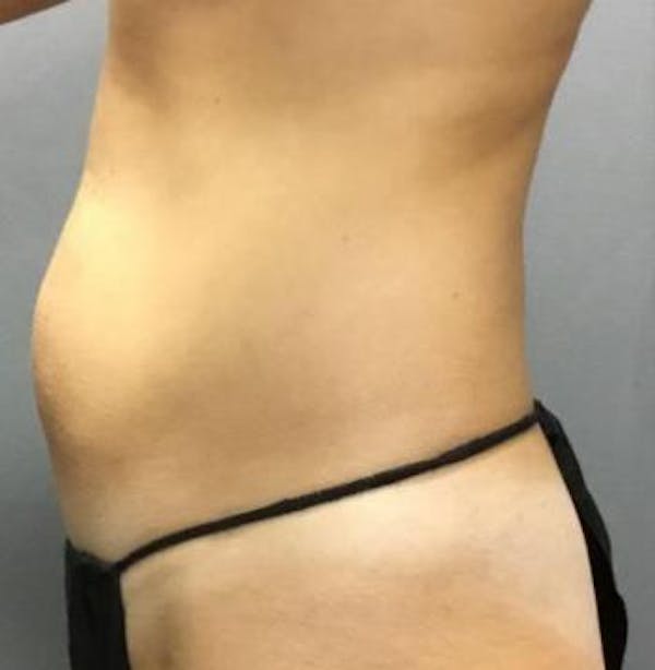 Microcannula Liposuction Before & After Gallery - Patient 5070685 - Image 3