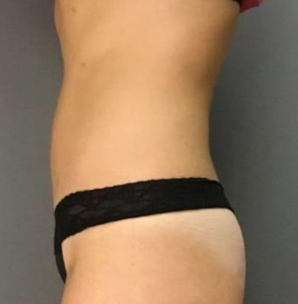 Microcannula Liposuction Before & After Gallery - Patient 5070685 - Image 4