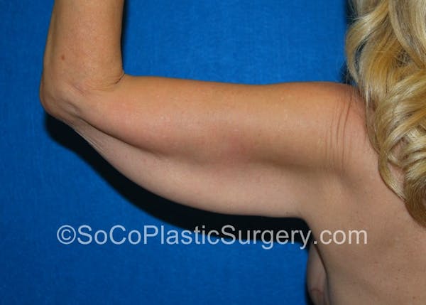 Brachioplasty in Irvine