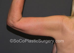 Brachioplasty in Irvine