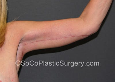 Brachioplasty Before & After Gallery - Patient 5070694 - Image 4