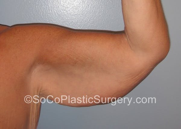 Brachioplasty Before & After Gallery - Patient 5070703 - Image 1