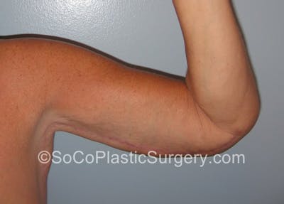 Brachioplasty Before & After Gallery - Patient 5070703 - Image 2