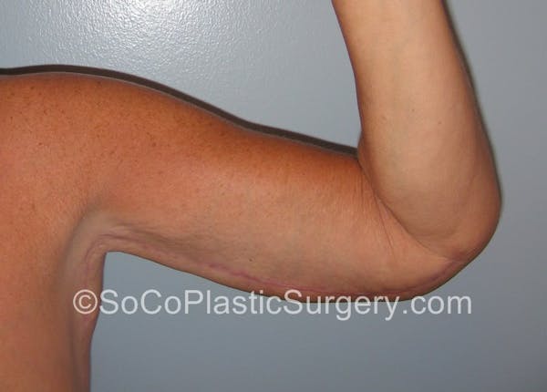 Brachioplasty Before & After Gallery - Patient 5070703 - Image 2