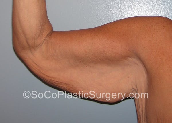 Brachioplasty Before & After Gallery - Patient 5070703 - Image 3