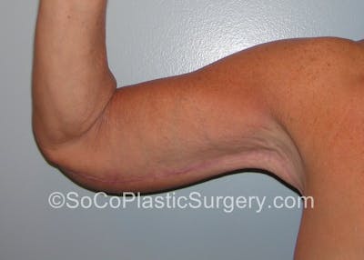 Brachioplasty Before & After Gallery - Patient 5070703 - Image 4