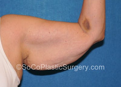 Brachioplasty Before & After Gallery - Patient 5070714 - Image 1