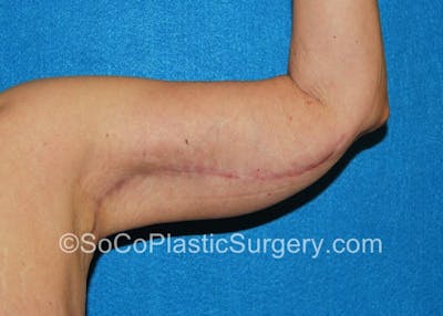 Brachioplasty Before & After Gallery - Patient 5070714 - Image 2