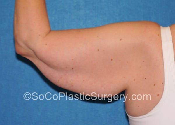 Brachioplasty Before & After Gallery - Patient 5070714 - Image 3