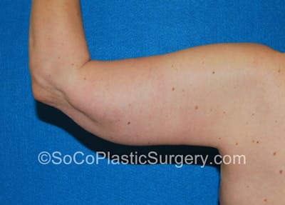 Brachioplasty Before & After Gallery - Patient 5070714 - Image 4