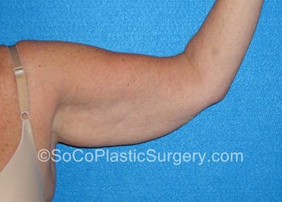 Brachioplasty Before & After Gallery - Patient 5070718 - Image 1