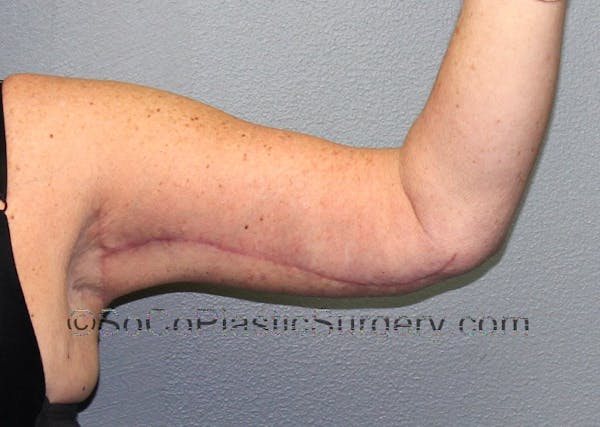 Brachioplasty Before & After Gallery - Patient 5070718 - Image 2