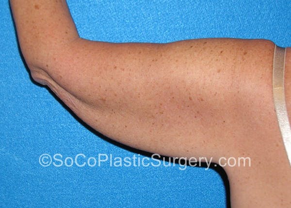 Brachioplasty Before & After Gallery - Patient 5070718 - Image 3