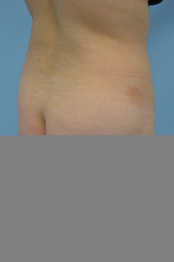 Brazilian Butt Lift Before & After Gallery - Patient 5070738 - Image 3