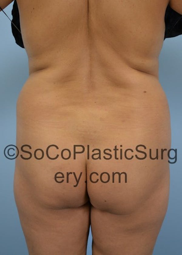 Brazilian Butt Lift Before & After Gallery - Patient 5070757 - Image 1
