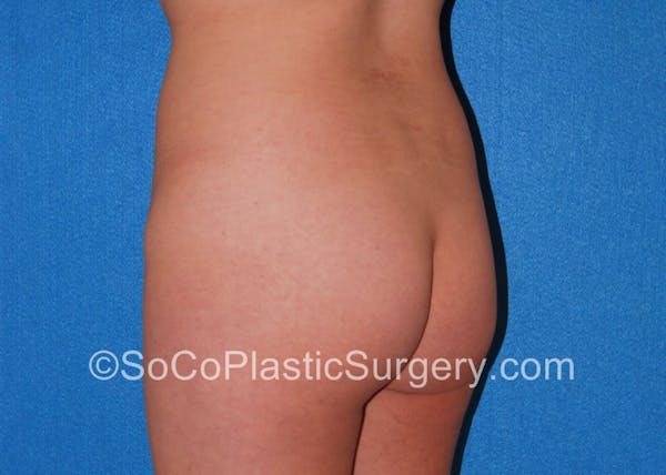 Brazilian Butt Lift Before & After Gallery - Patient 5070805 - Image 2