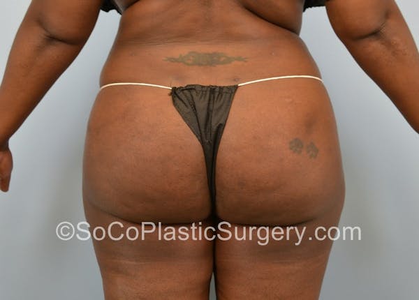 Brazilian Butt Lift Before & After Gallery - Patient 5070817 - Image 2