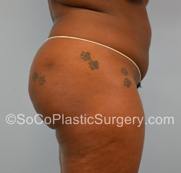 Brazilian Butt Lift Before & After Gallery - Patient 5070817 - Image 4