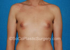 Before and After image of Gynecomastia in Irvine