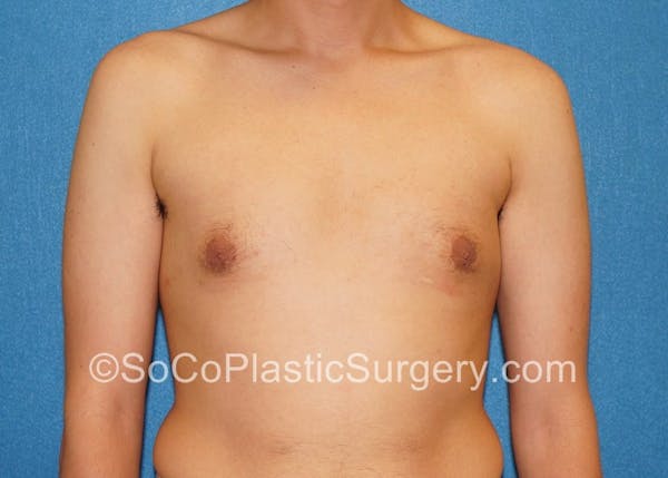 Before and After image of Gynecomastia in Irvine