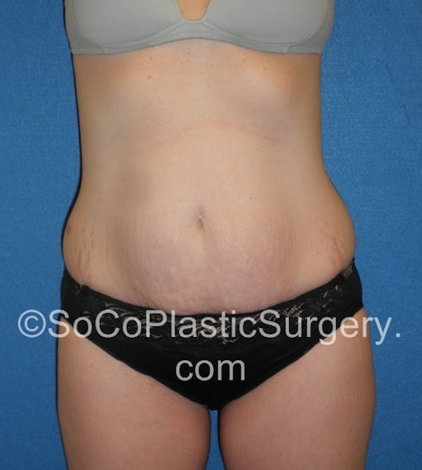 Tummy Tuck Before & After Gallery - Patient 5088730 - Image 1