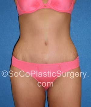 Before and After image of an Abdominoplasty done in Irvine