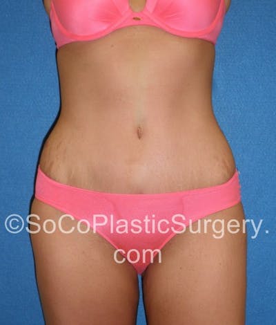 Tummy Tuck Before & After Gallery - Patient 5088730 - Image 2