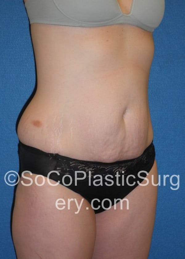 Tummy Tuck Before & After Gallery - Patient 5088730 - Image 3