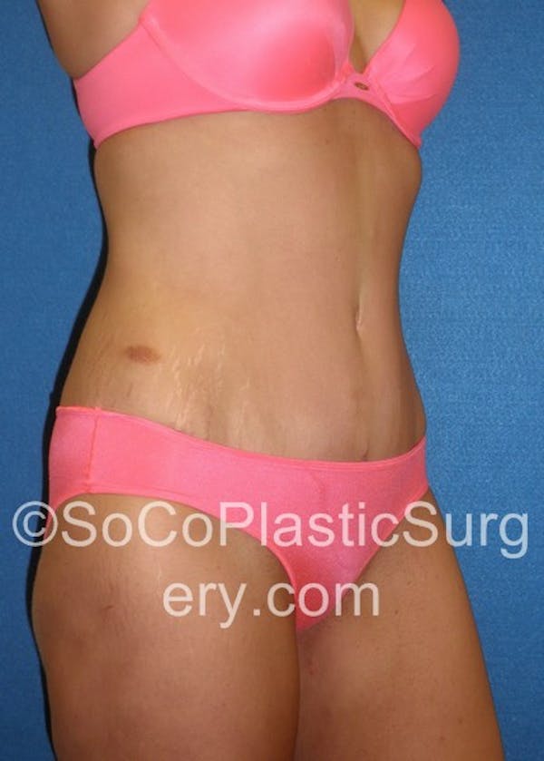 Tummy Tuck Before & After Gallery - Patient 5088730 - Image 4