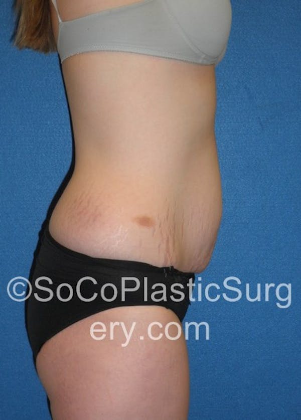 Tummy Tuck Before & After Gallery - Patient 5088730 - Image 5