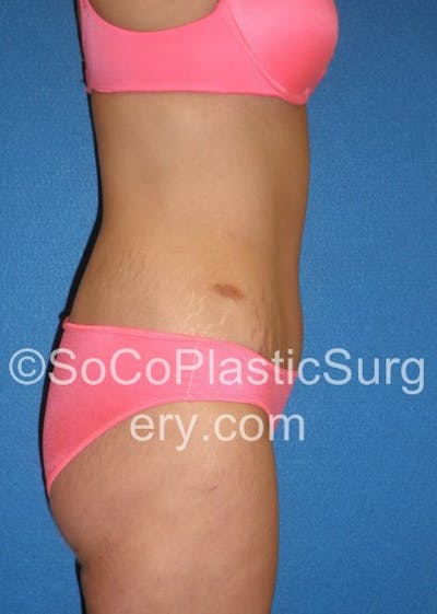 Tummy Tuck Before & After Gallery - Patient 5088730 - Image 6