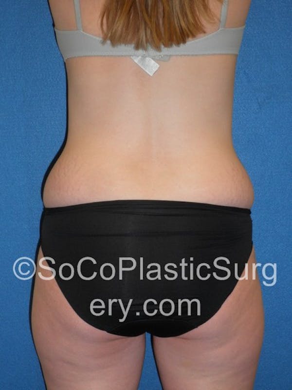 Tummy Tuck Before & After Gallery - Patient 5088730 - Image 7