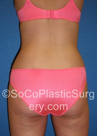 Tummy Tuck Before & After Gallery - Patient 5088730 - Image 8