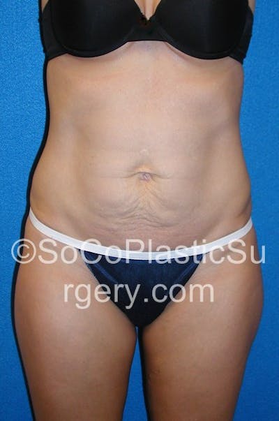 Tummy Tuck Before & After Gallery - Patient 5088812 - Image 1