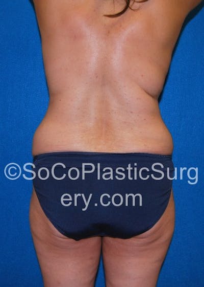 Tummy Tuck Before & After Gallery - Patient 5088907 - Image 1