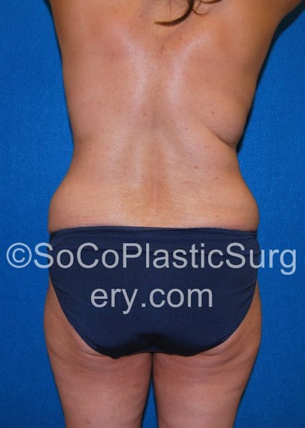 Tummy Tuck Gallery - Patient 5088907 - Image 1