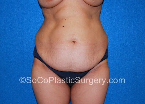 Tummy Tuck Before & After Gallery - Patient 5088907 - Image 3