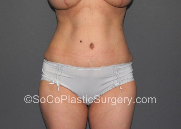 Tummy Tuck Before & After Gallery - Patient 5088907 - Image 4