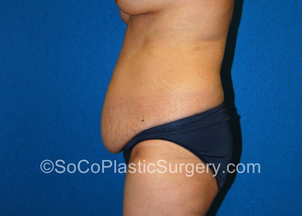 Tummy Tuck Before & After Gallery - Patient 5088907 - Image 7