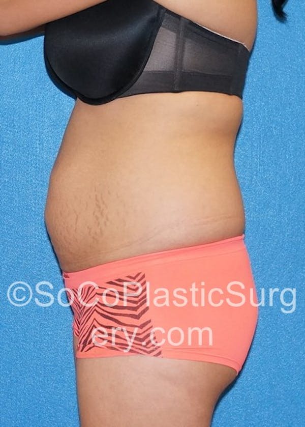 Tummy Tuck Before & After Gallery - Patient 5088994 - Image 5