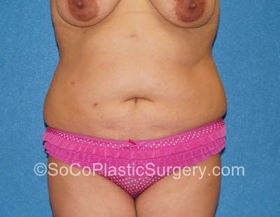 Tummy Tuck Before & After Gallery - Patient 5089122 - Image 1