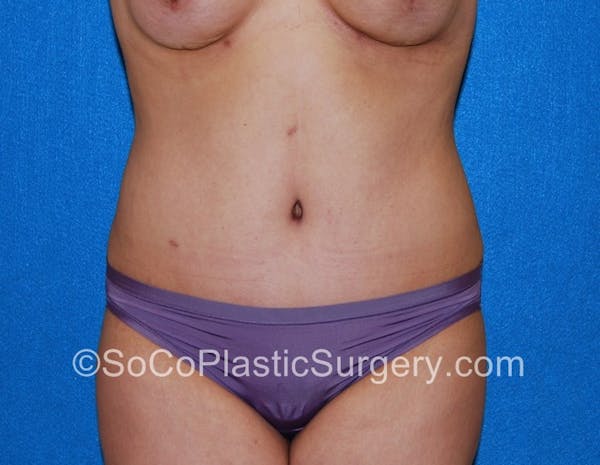 Tummy Tuck Before & After Gallery - Patient 5089122 - Image 2