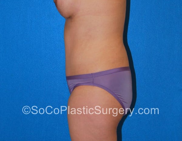 Tummy Tuck Gallery - Patient 5089122 - Image 6