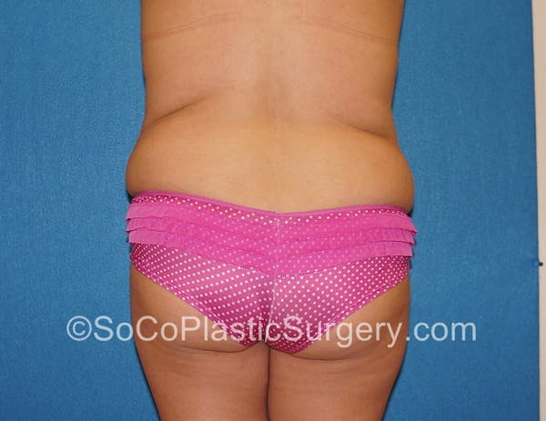 Tummy Tuck Before & After Gallery - Patient 5089122 - Image 7