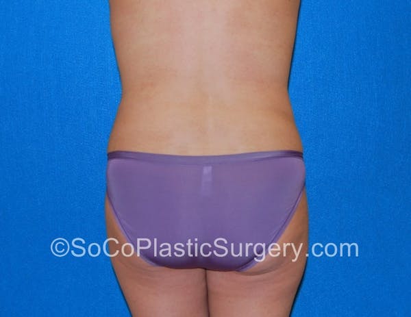 Tummy Tuck Before & After Gallery - Patient 5089122 - Image 8