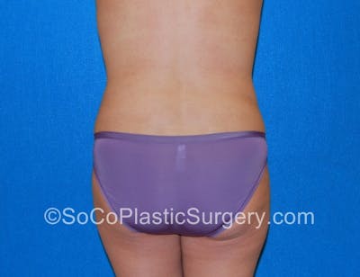 Tummy Tuck Before & After Gallery - Patient 5089122 - Image 8