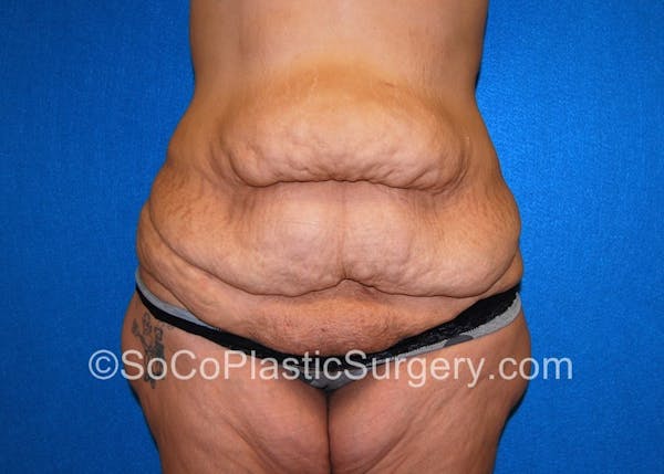 Tummy Tuck Before & After Gallery - Patient 5089235 - Image 1